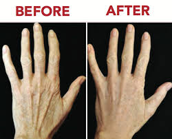 PRFM Gel Injections Mini (5 mL)