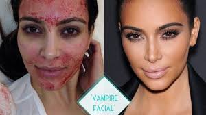 Vampire Facial®- One Powerful Anti-Aging Solution Chosen by Celebrities